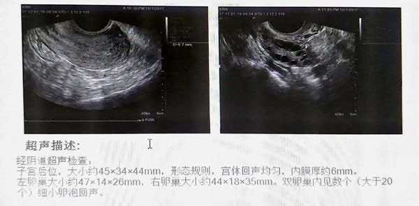 垂体功能亢进_幼稚子宫能生育吗_做滁州助孕试管婴儿详细过程是什么的
